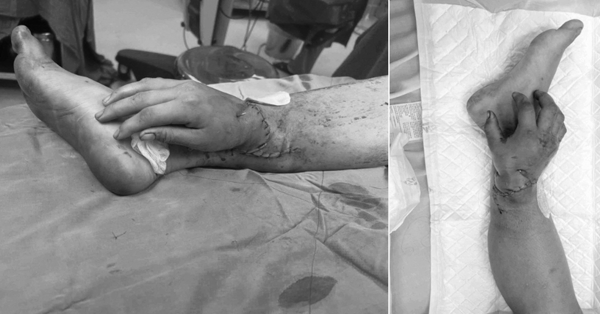 Bàn tay ghép vào chân sản phụ mang song thai đã hồng hào