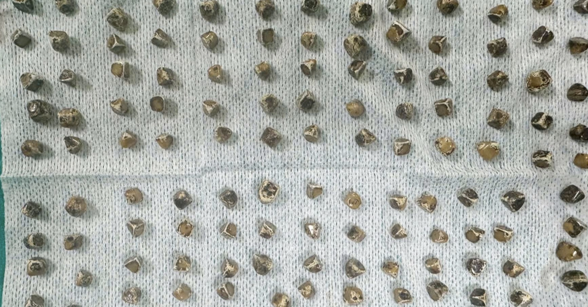 Đau bụng đi khám, người phụ nữ sốc khi bác sĩ lấy ra 130 viên sỏi mật