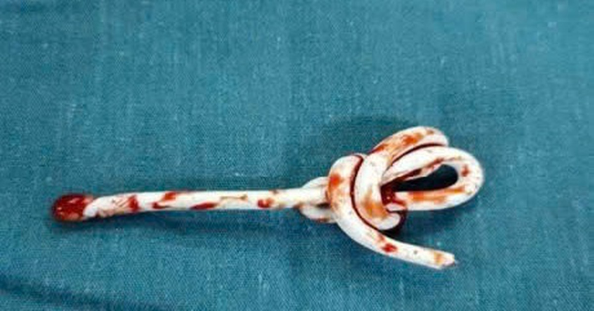 Bé trai cấp cứu do nhét dây vào lỗ tiểu, theo clip 'thử thách' trên mạng