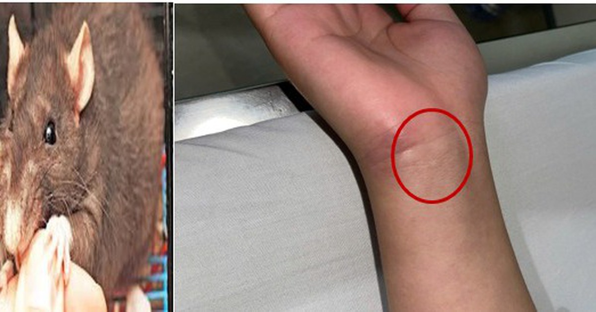 Cảnh báo bệnh lý nguy hiểm khi bị chuột cắn