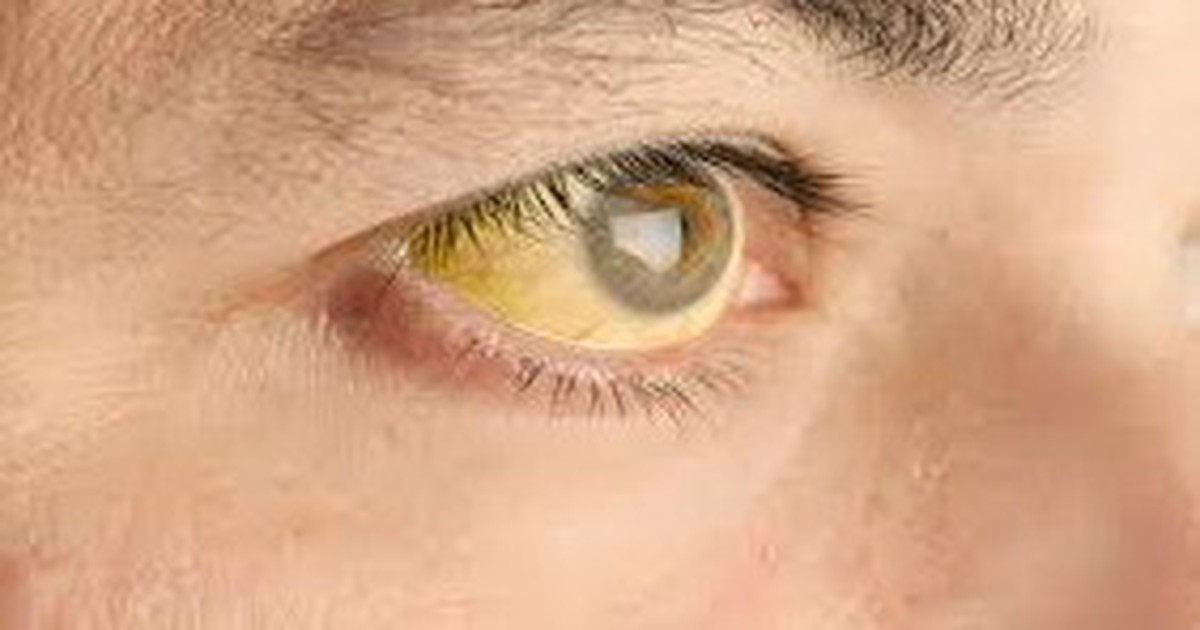 Bỗng vàng da, vàng mắt: Có thể là dấu hiệu cảnh báo gan mật đang gặp vấn đề