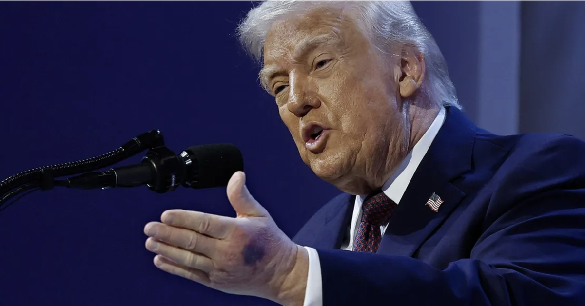 Vì sao tay ông Trump xuất hiện vết bầm khi dự Diễn đàn Kinh tế Davos?