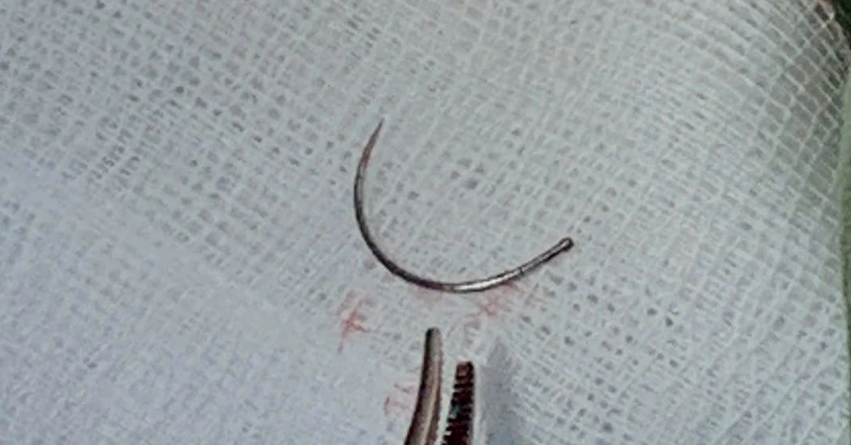 Lấy dị vật kim khâu nằm trong tầng sinh môn nữ bệnh nhân sau 11 năm