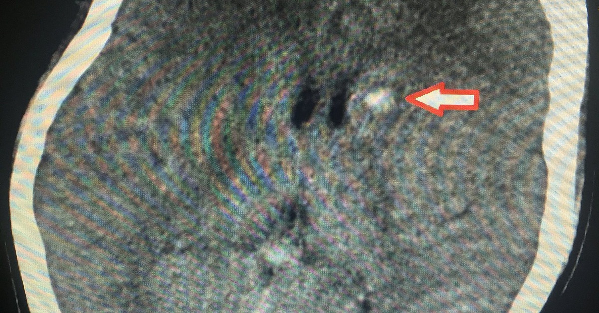 Mông, đùi chảy mủ sau khi tiêm chất làm đầy