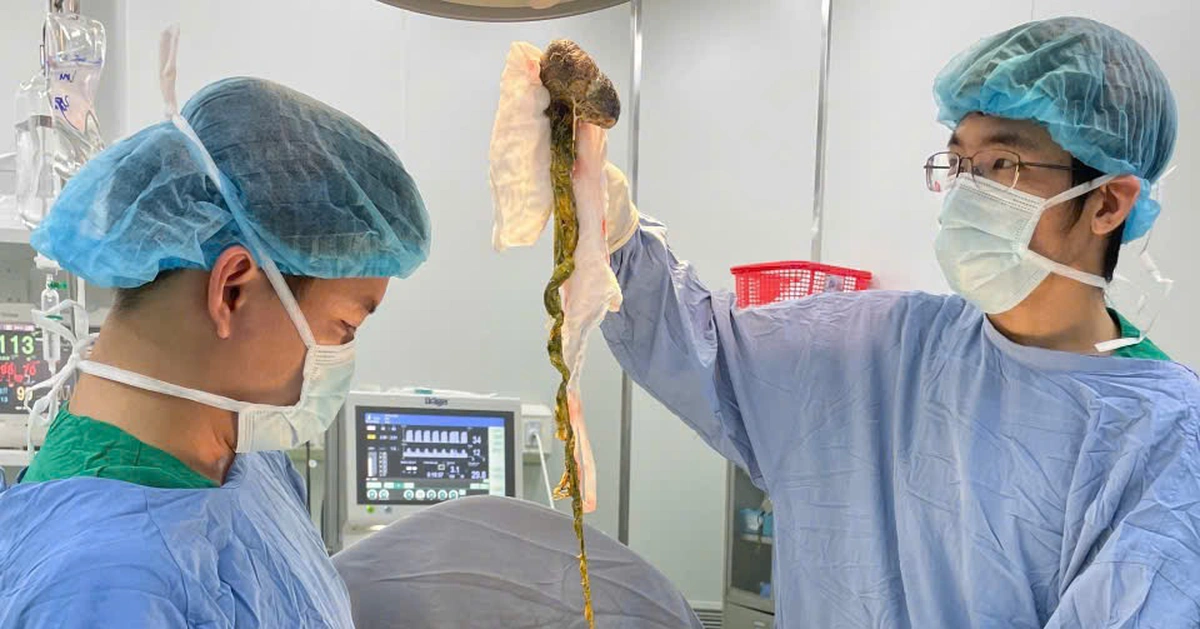 Phẫu thuật lấy búi tóc chiếm hết dạ dày bé trai 6 tuổi