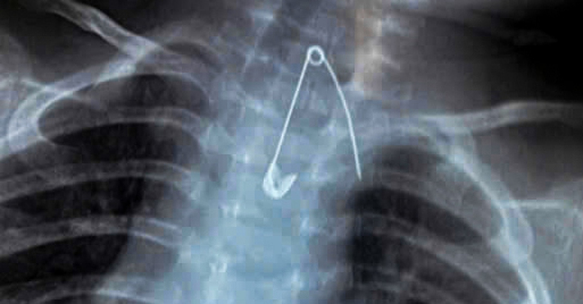 Cứu sống hai em bé nuốt kim băng và cây kẹo mút