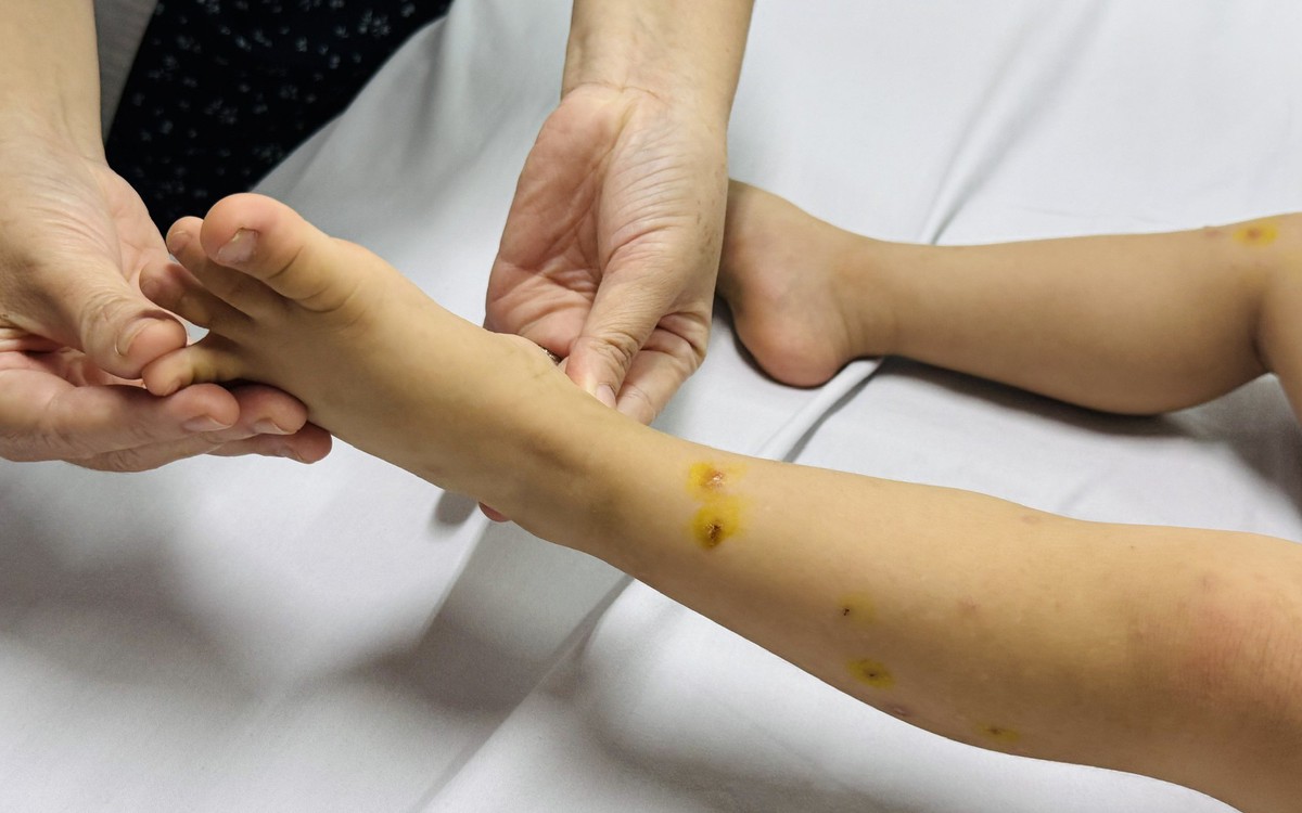 TP.HCM ghi nhận hơn 44.000 ca tay chân miệng, nhiều ca dương tính vi rút EV71 gây bệnh nặng