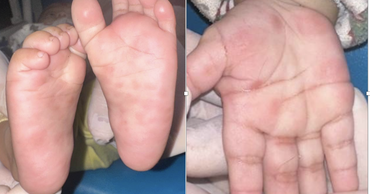 Bé trai gần 3 tuổi mắc giang mai dù không có triệu chứng