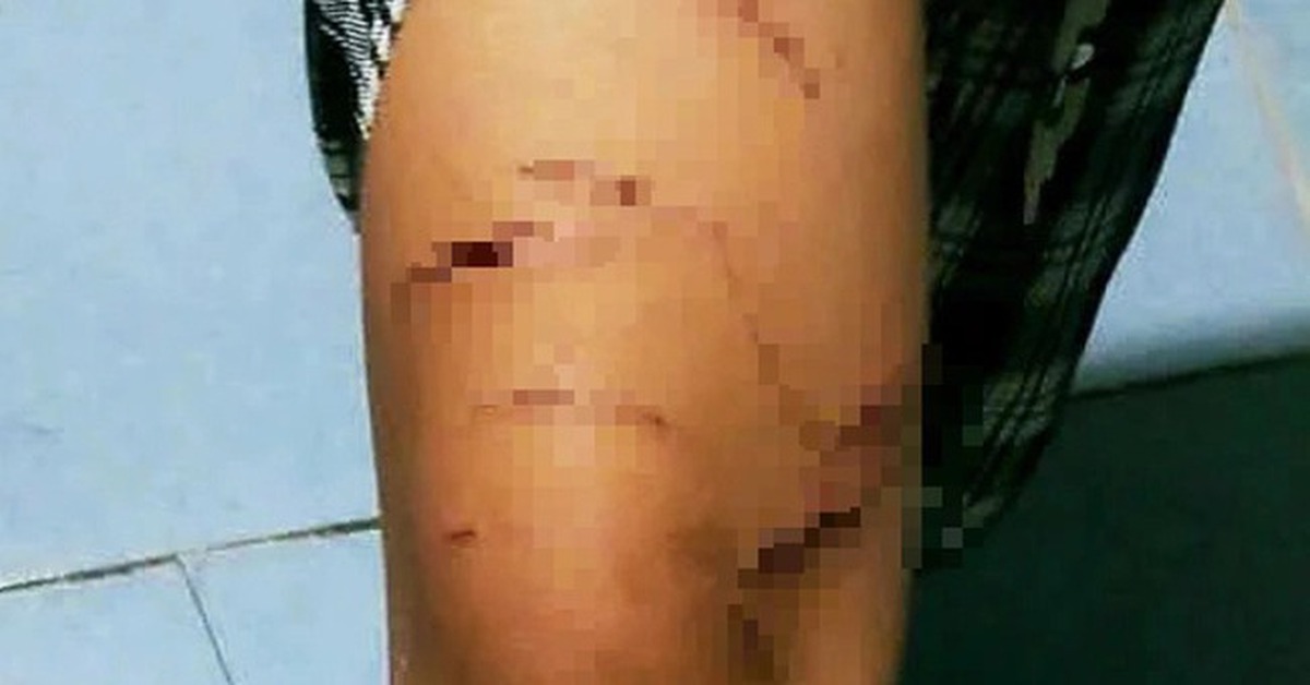 Vụ bé gái bị rạch nhiều vết trên người: Giao 'thủ phạm' cho gia đình, nhà trường quản lý, giáo dục