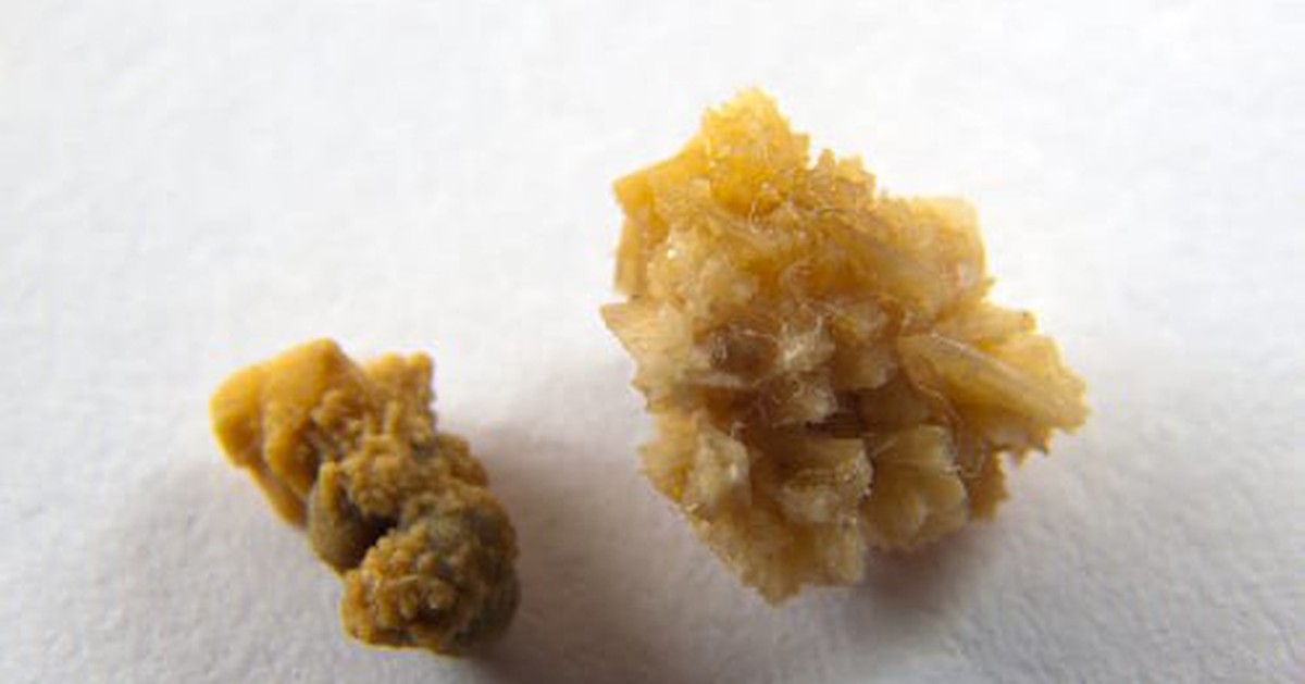 Nhóm đạo chích đột nhập nhà tổng biên tập, tưởng trộm được vàng, không ngờ lấy nhầm sỏi thận