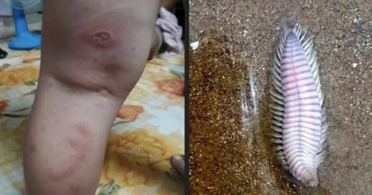 'Bé 3 tuổi bị rết biển cắn cần máu hiếm' gây 'bão' chia sẻ: Hóa ra là tin vịt