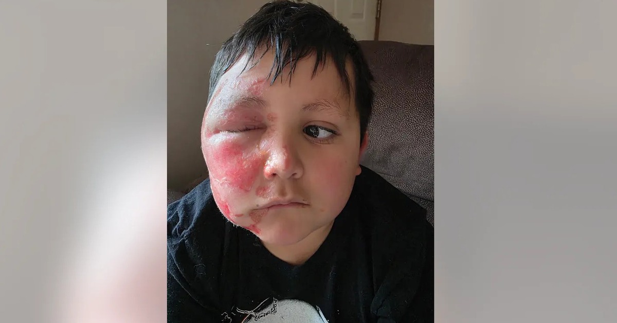 Bé trai bỏng nặng vì làm theo trào lưu TikTok cho đồ chơi vào lò vi sóng