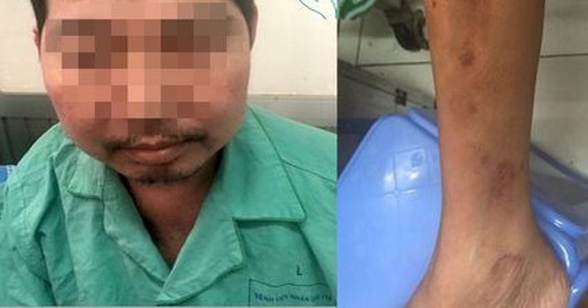 'Uống thấy dễ chịu' nhưng khuôn mặt biến dạng, suy thượng thận mạn vì lạm dụng corticoid