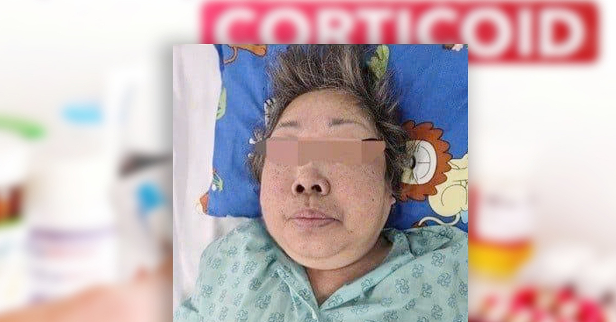 'Uống thấy dễ chịu' nhưng khuôn mặt biến dạng, suy thượng thận mạn vì lạm dụng corticoid