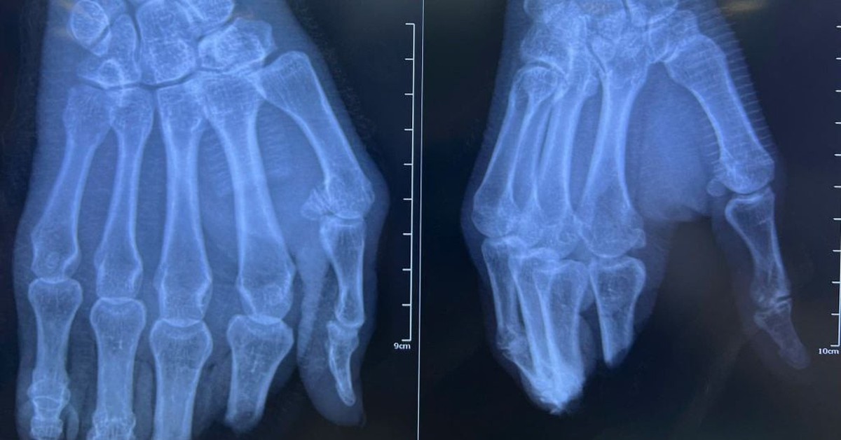 8 tiếng phẫu thuật nối 4 ngón tay đứt lìa