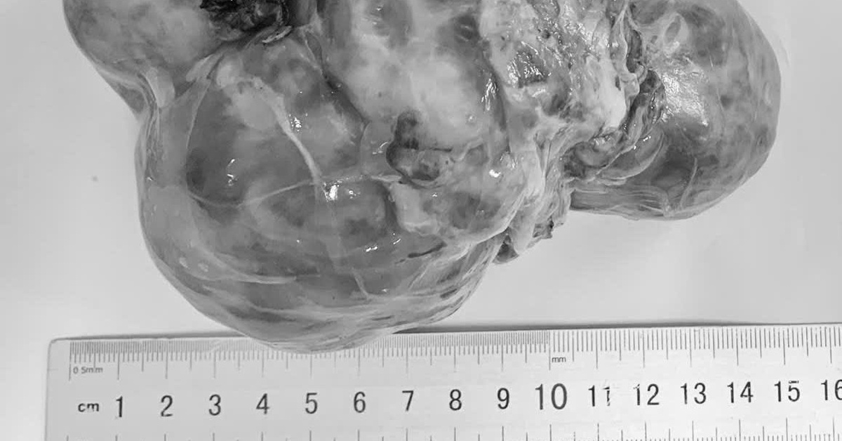 Liên tiếp trẻ mổ u ổ bụng, dấu hiệu ban đầu dễ nhầm với vấn đề tiêu hóa