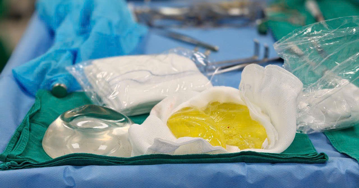 Phát hiện túi ngực vỡ vụn sau 5 năm: Bác sĩ cảnh báo biến chứng âm thầm dễ bỏ qua