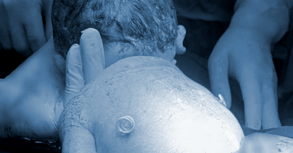 Em bé sinh ra với ‘đôi cánh nhỏ’ trên lưng mẹ