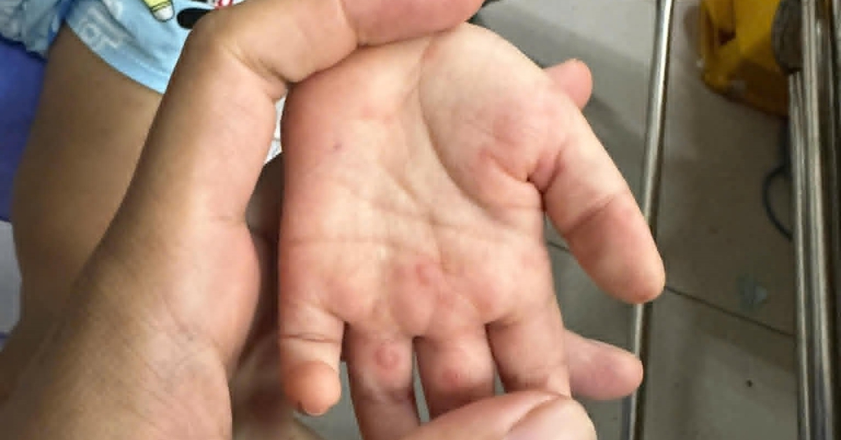 Báo động trẻ tử vong vì bệnh tay chân miệng tăng nhanh