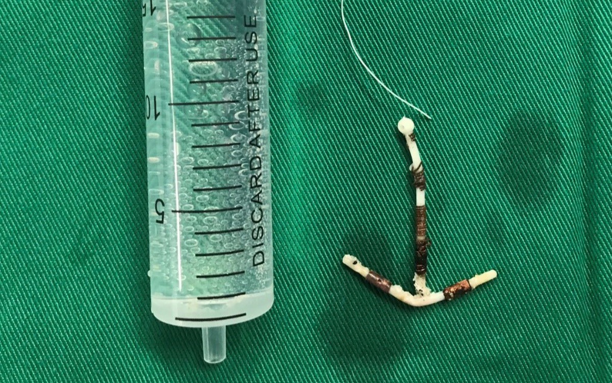 Lấy vòng tránh thai lạc chỗ suốt 1/4 thế kỷ