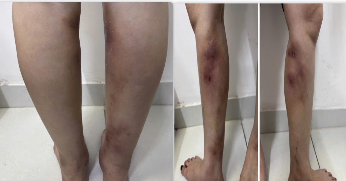 Chân biến dạng sau tiêm filler làm thẳng chân tại nhà