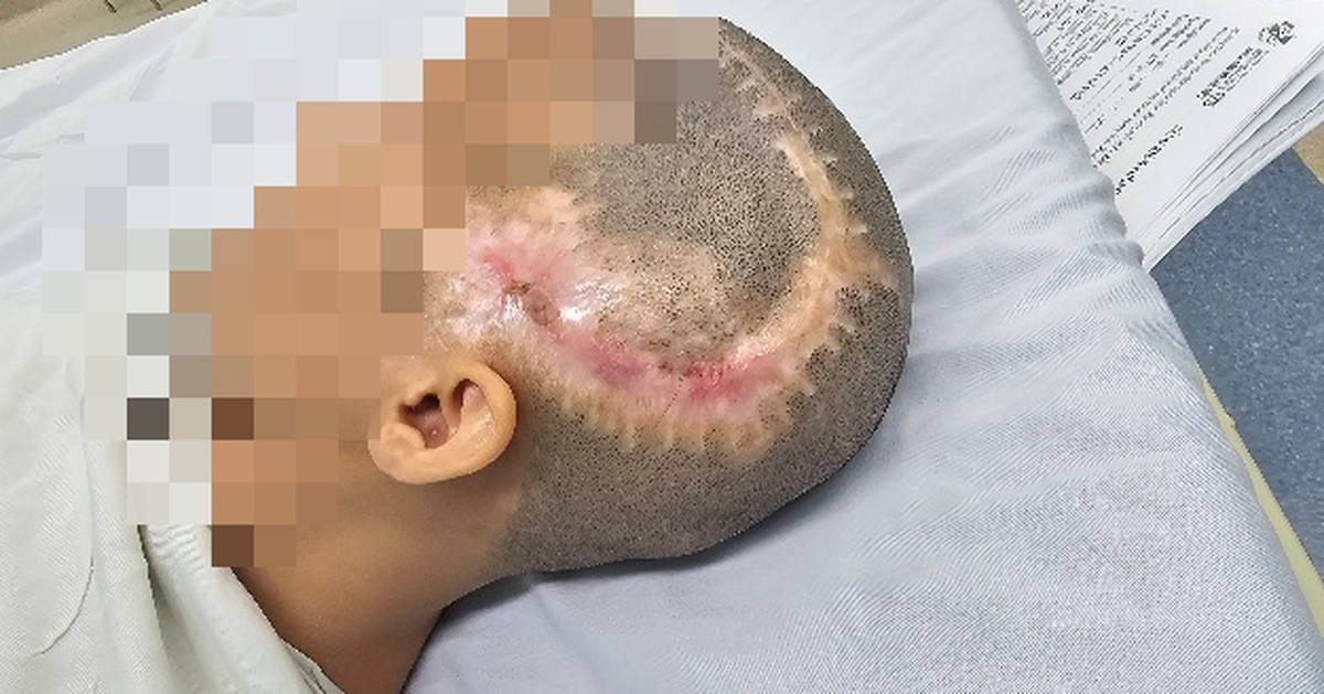 Cô gái 33 tuổi đột quỵ sau khi bơm mỡ tự thân vào vùng thái dương làm đẹp