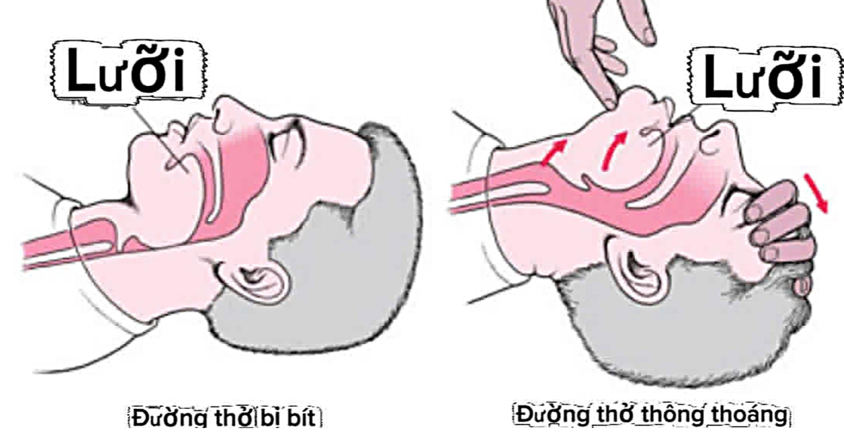 Đừng kéo lưỡi khi cấp cứu 'nuốt lưỡi'