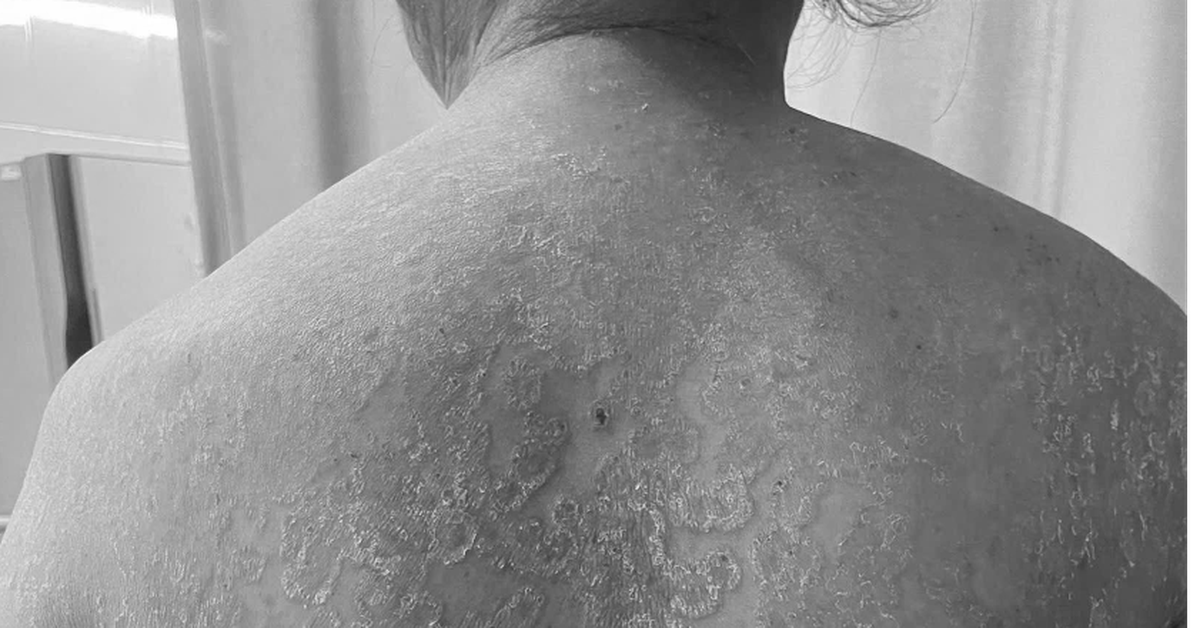 Tự ý bôi kem trộn, tắm lá, người phụ nữ bị nấm da lan khắp cơ thể