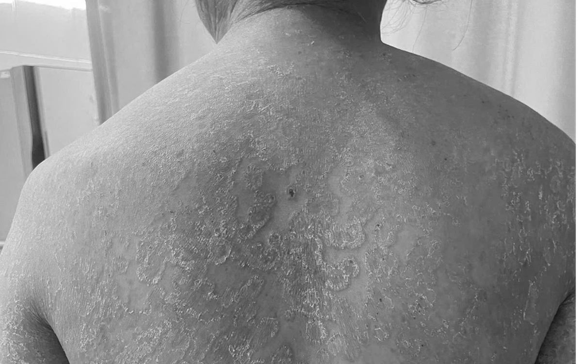 Tự ý bôi kem trộn, tắm lá, người phụ nữ bị nấm da lan khắp cơ thể