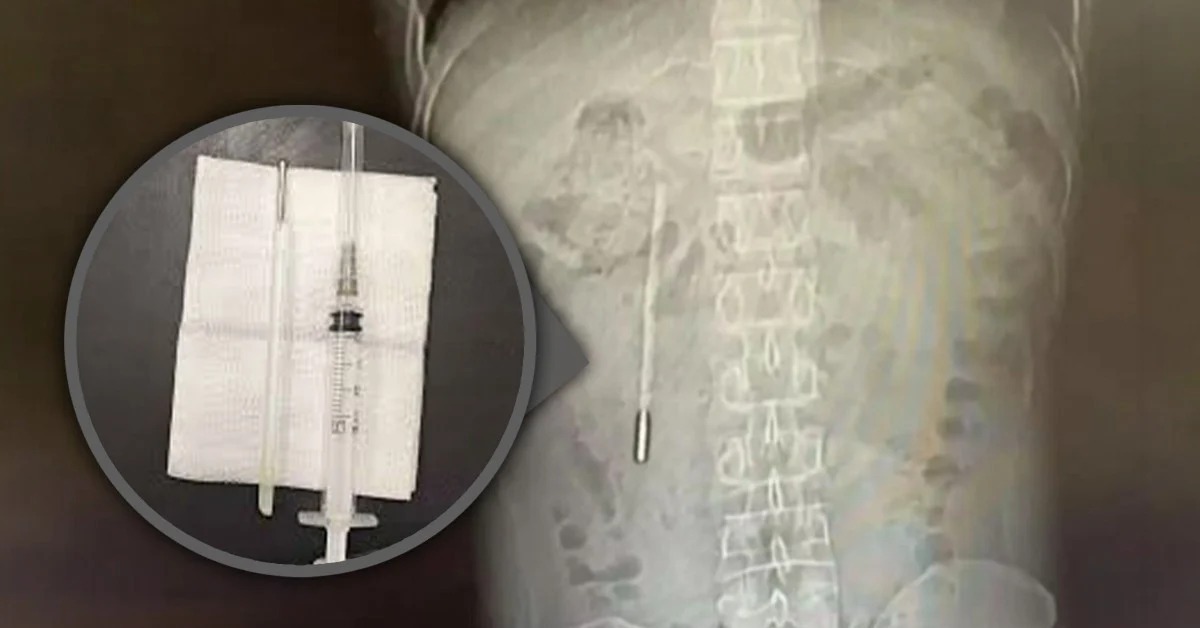 Đau bụng đi khám, phát hiện nhiệt kế nằm trong cơ thể suốt 20 năm