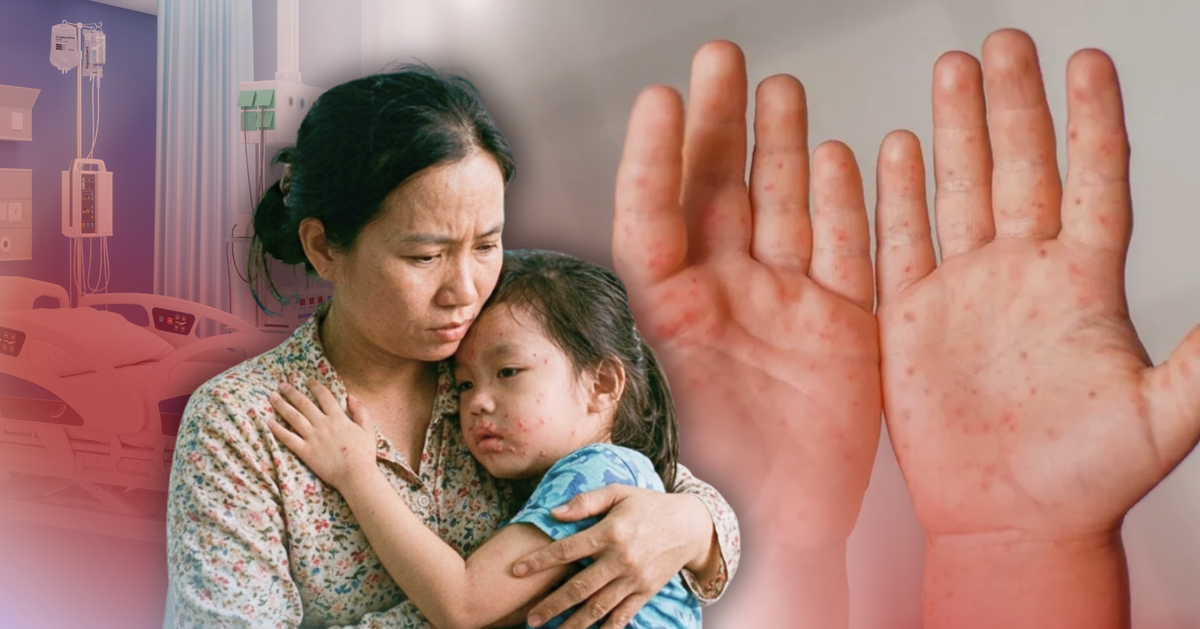 Ba bệnh rình rập trẻ nhỏ mùa nắng