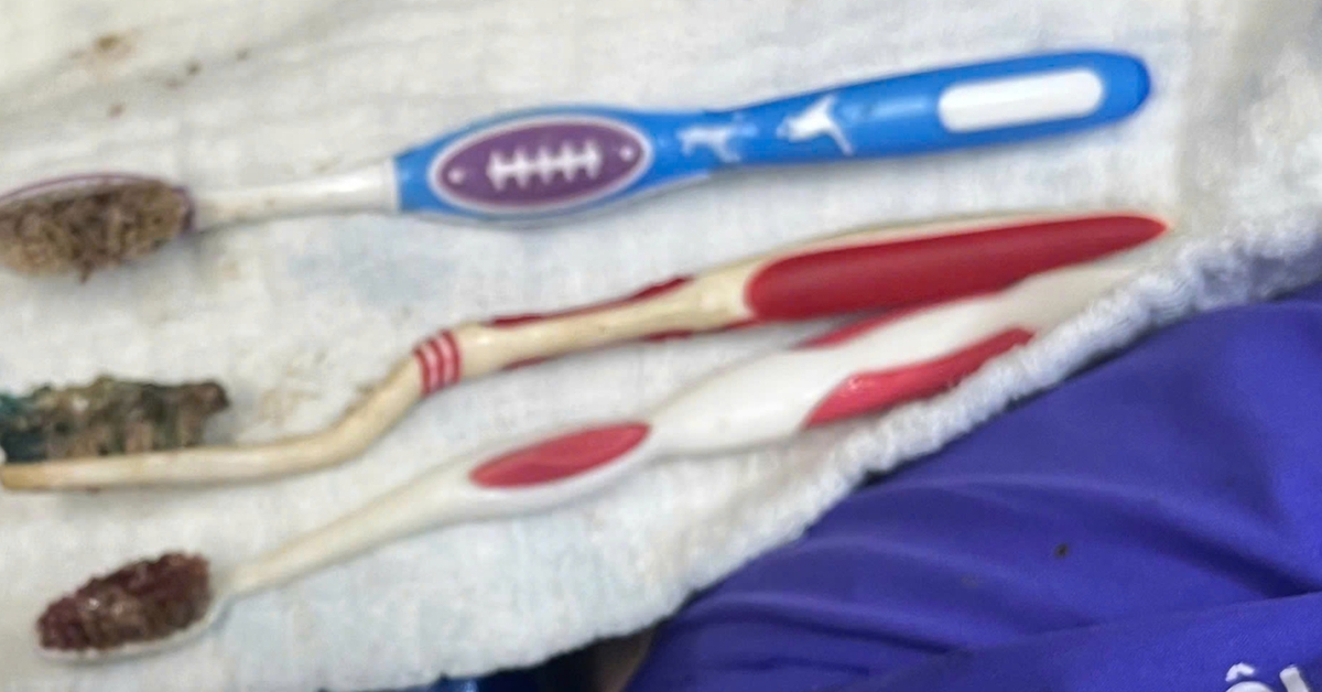 Nuốt 3 bàn chải đánh răng, nam bệnh nhân được cứu bằng nội soi