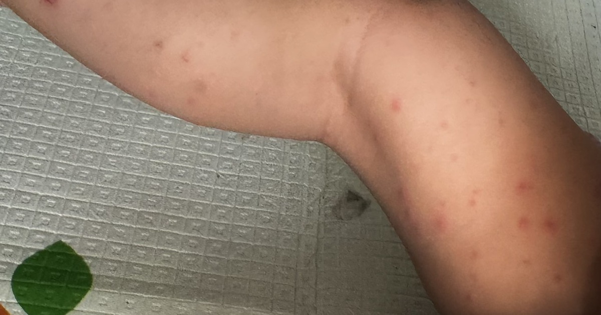 TP.HCM: Hơn 1.300 ca tay chân miệng trong một tuần, cao hơn ngưỡng cảnh báo