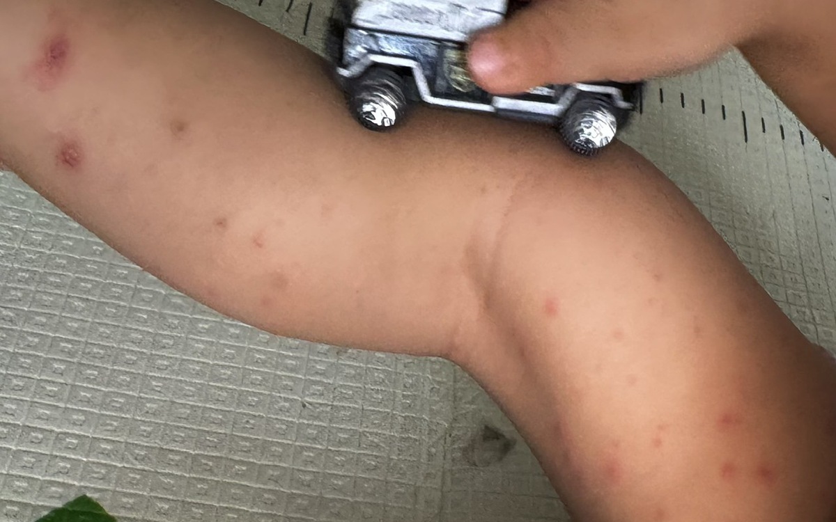 TP.HCM: Hơn 1.300 ca tay chân miệng trong một tuần, cao hơn ngưỡng cảnh báo