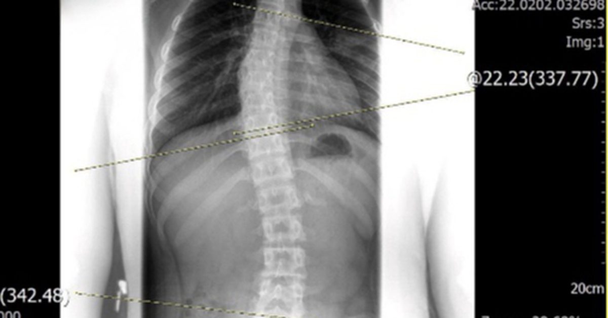 Chỉnh dáng cho trẻ vẹo cột sống bằng cách nào?