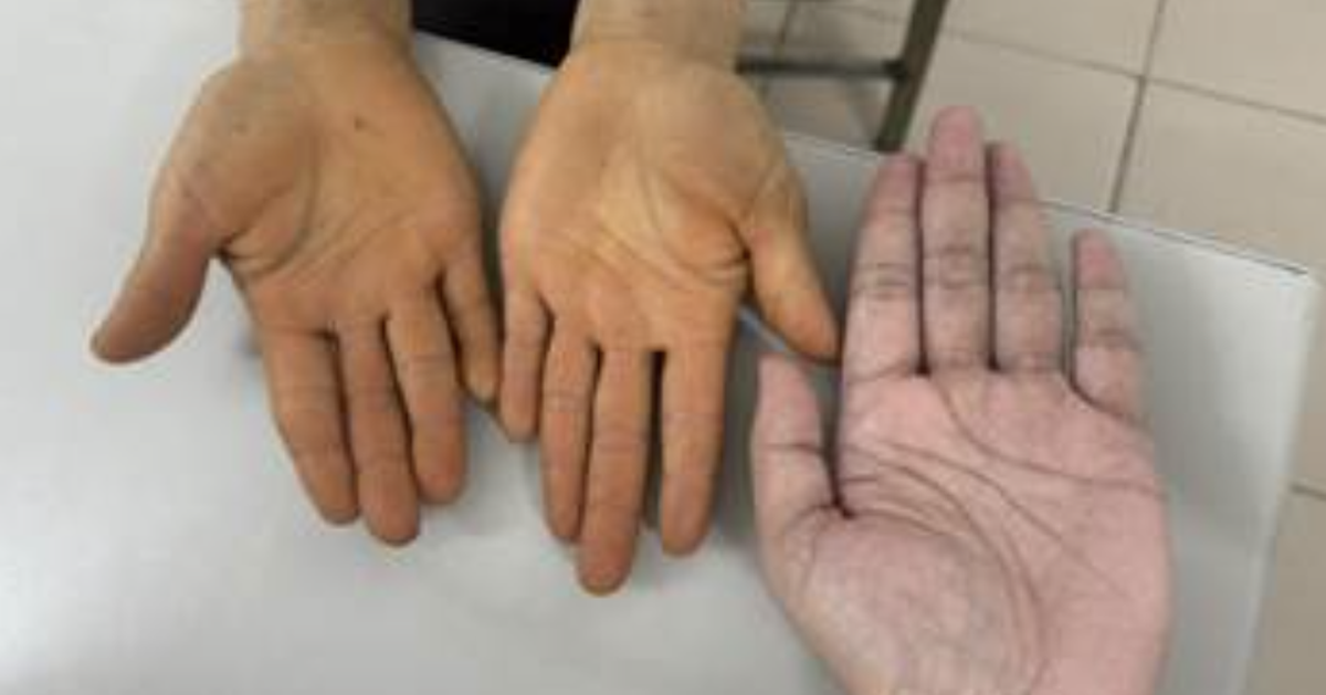 Không mắc bệnh về gan, tại sao lòng bàn tay, bàn chân chuyển màu vàng?