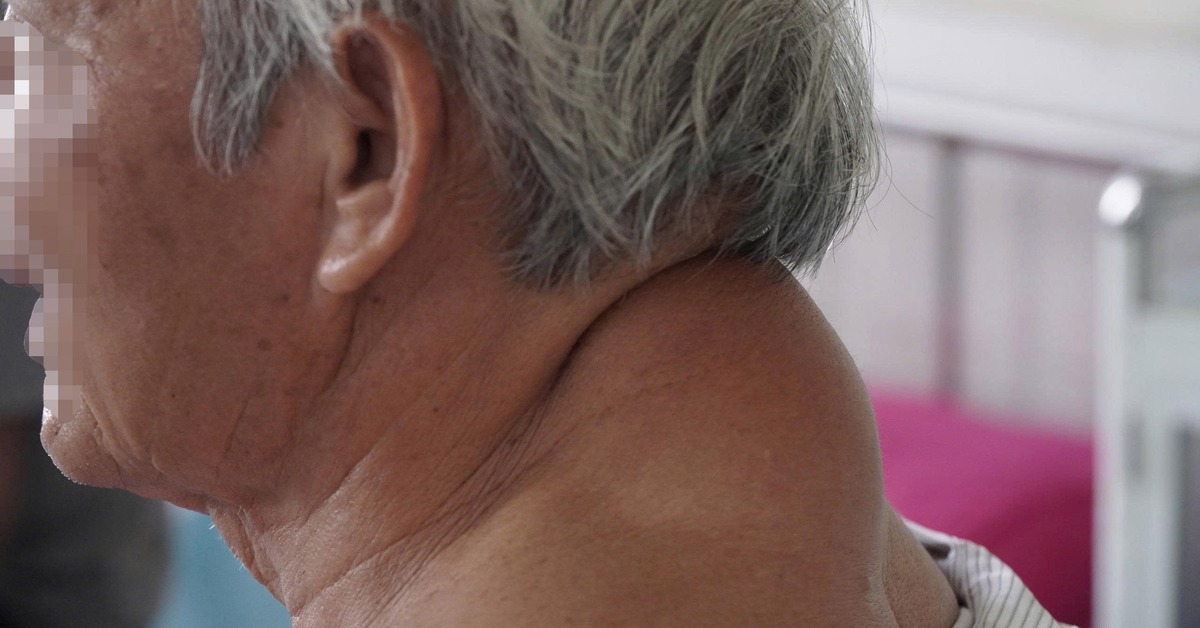 Phẫu thuật bóc khối u 'khổng lồ' vùng sau cổ suốt hơn 40 năm cho cụ ông 72 tuổi