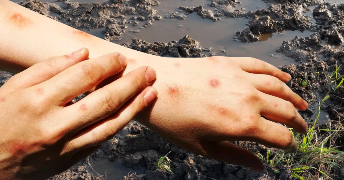 Thái Lan cảnh báo khẩn bệnh ‘sốt đất’, hơn 700 ca mắc, 23 người tử vong trong 4 tháng