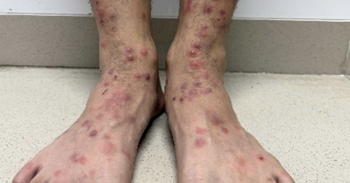 Bọ chét chó mèo ‘tấn công’ người, gây ngứa ngáy, viêm da vì điều trị sai cách