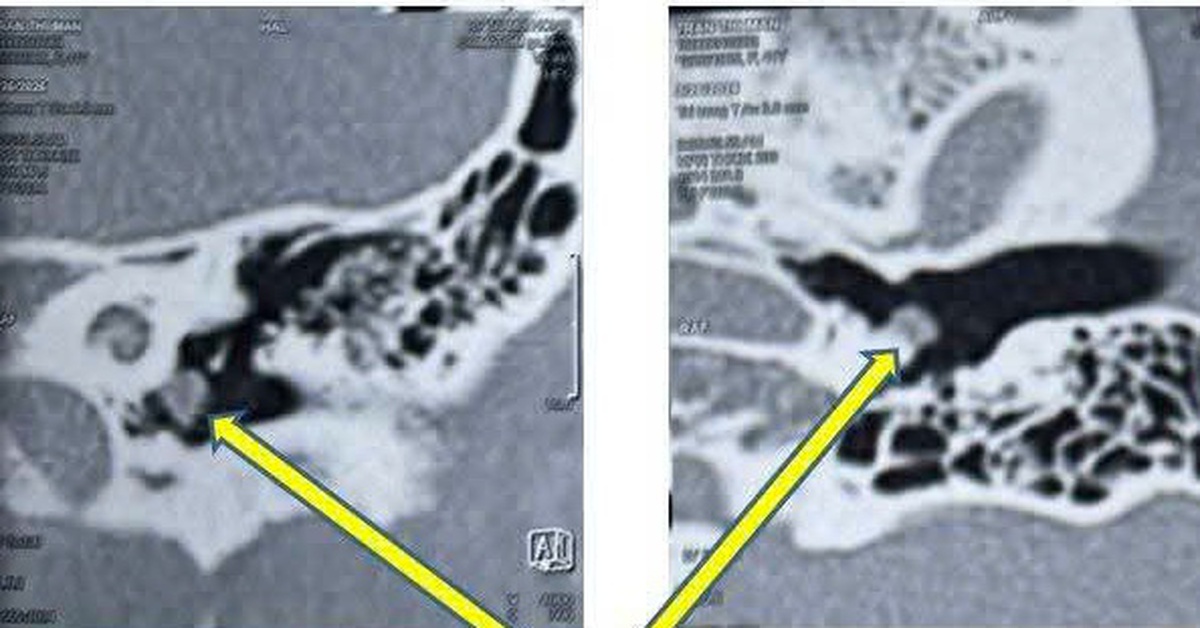 Bệnh nhân bị ù tai đến khám, bác sĩ bất ngờ phát hiện bệnh lạ