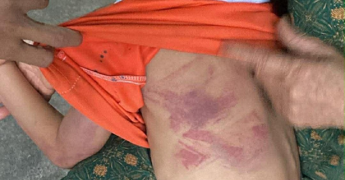 Bé gái lớp 2 bị bạn đánh bầm tím người trong giờ ra chơi