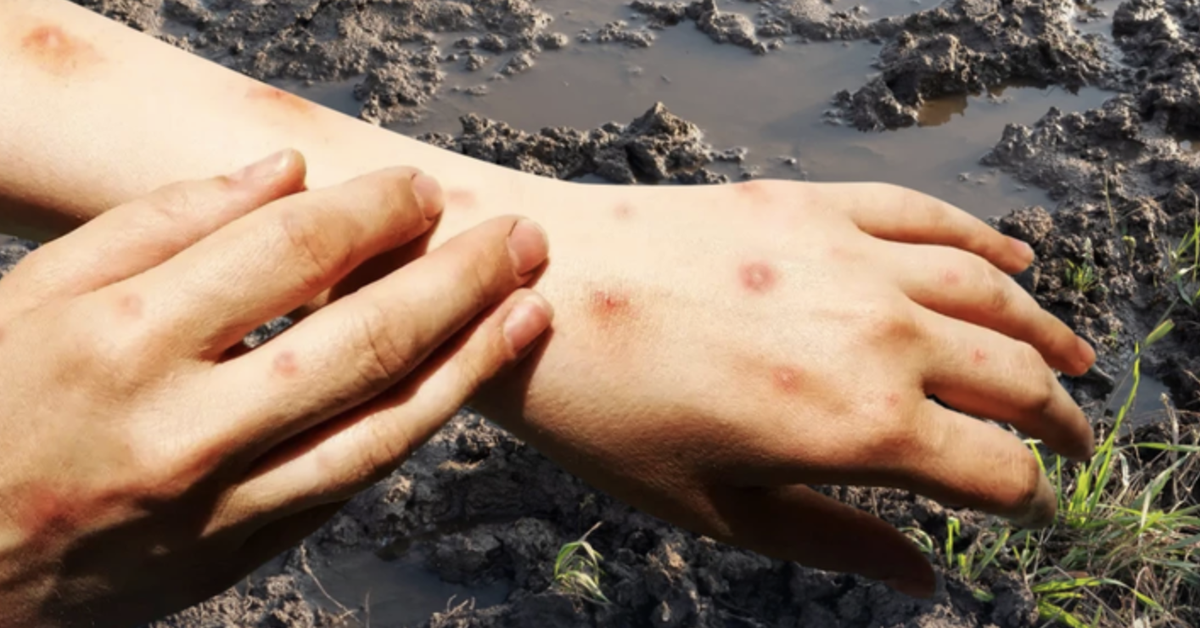 Bệnh ‘sốt đất’ làm 23 người chết tại Thái Lan: Bộ Y tế cảnh báo, đưa ra các biện pháp phòng ngừa