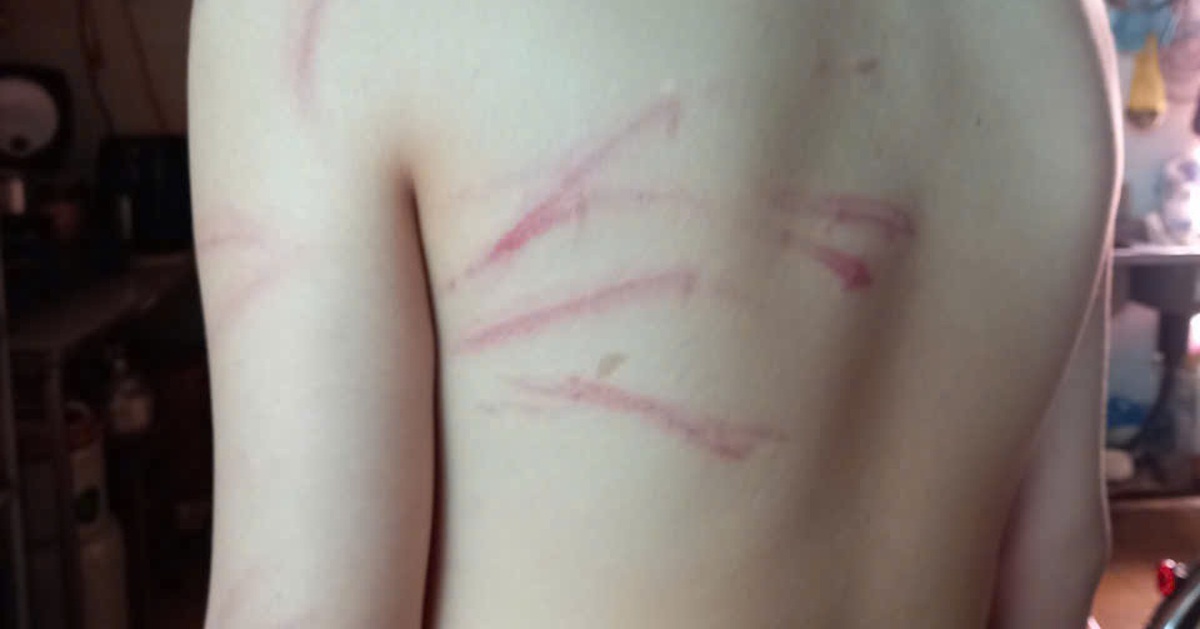 Vụ đi học thêm bị thầy đánh bầm tím: Tạm đình chỉ trung tâm dạy thêm