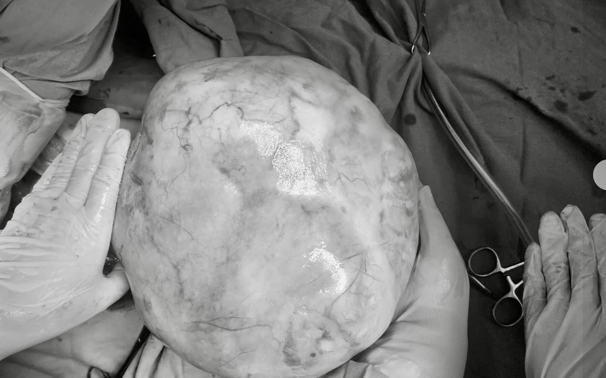 Hy hữu bé gái 14 tuổi mang khối u nặng hơn 4kg có răng, tóc, xương