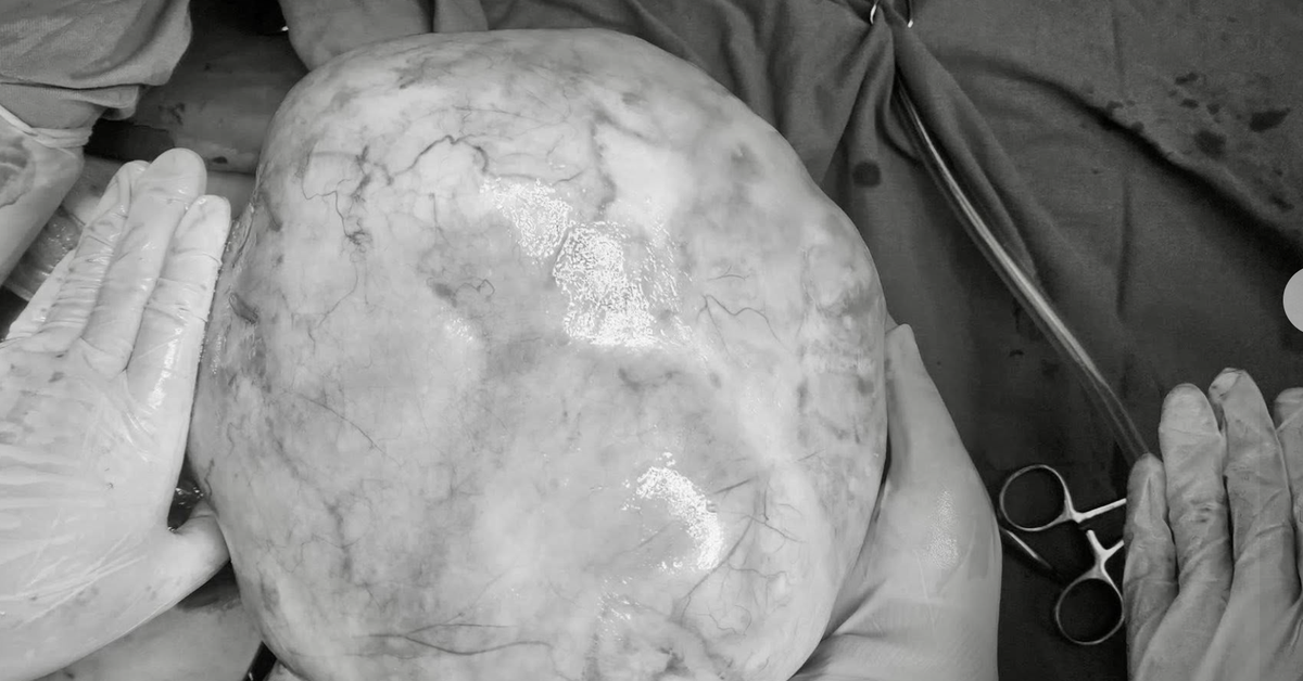 Hy hữu bé gái 14 tuổi mang khối u nặng hơn 4kg có răng, tóc, xương