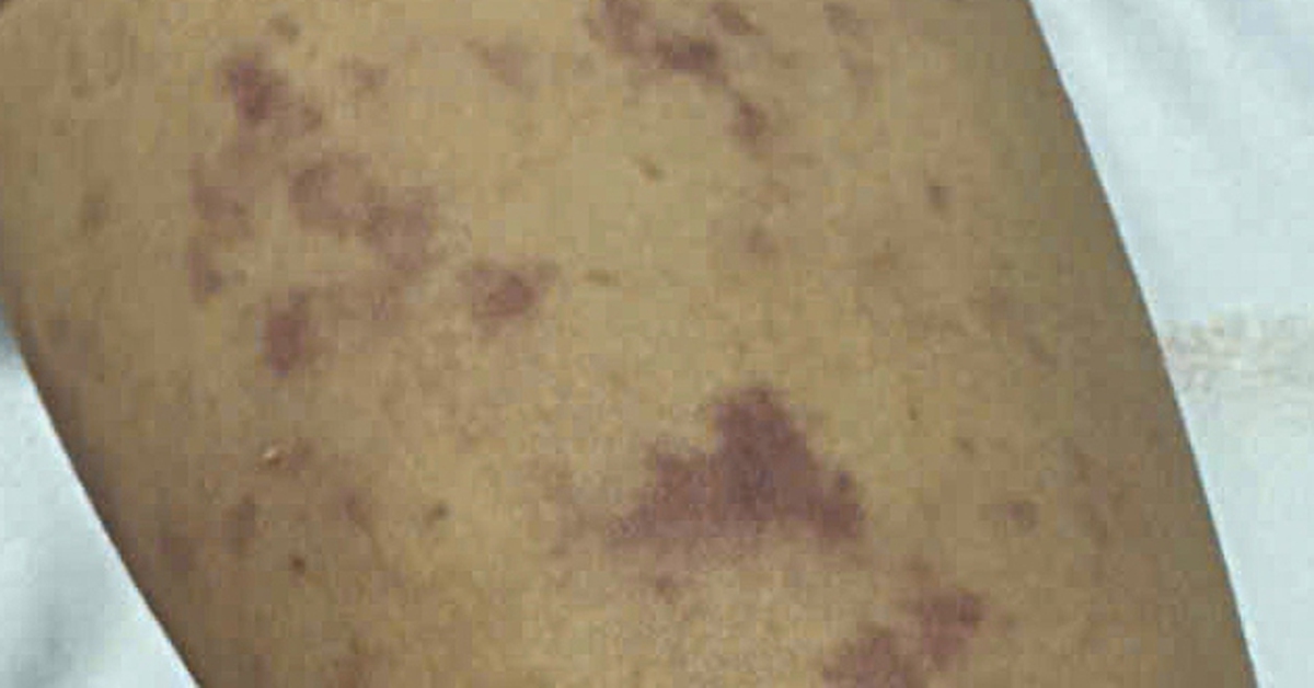 Viêm não mô cầu, 1 trẻ không qua khỏi