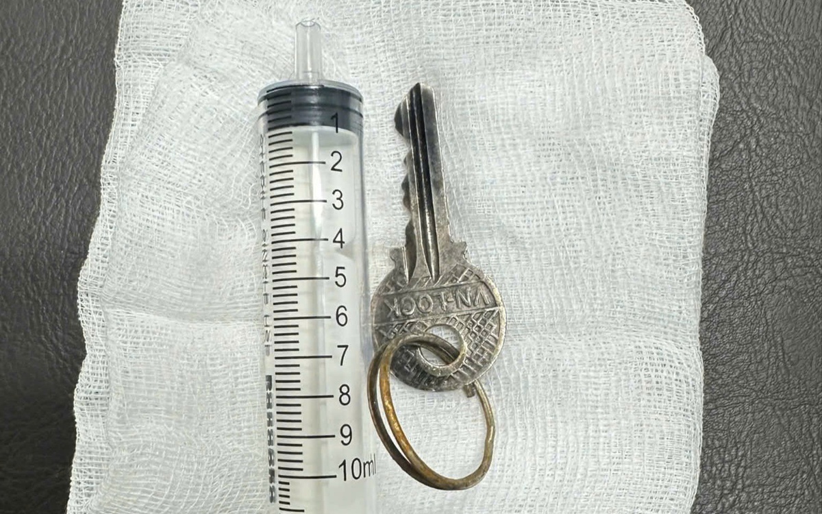 Bệnh nhi nuốt chìa khóa vào dạ dày, bác sĩ phải gây mê gắp ra ngoài