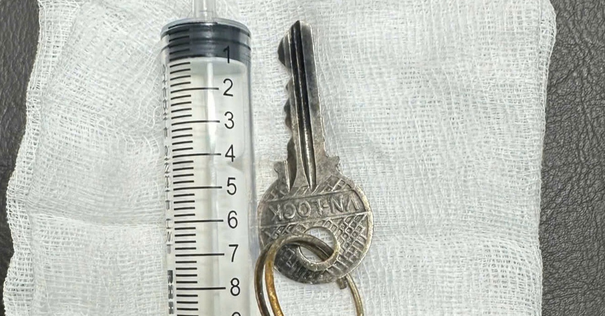 Bệnh nhi nuốt chìa khóa vào dạ dày, bác sĩ phải gây mê gắp ra ngoài