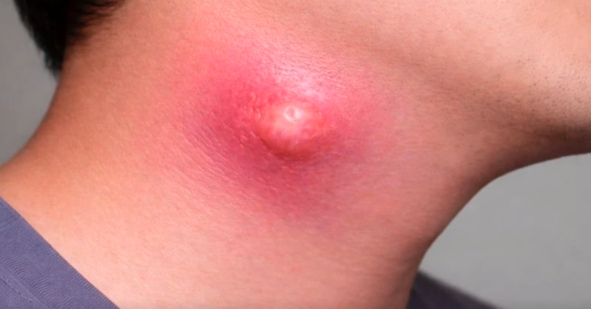 Đừng chủ quan với triệu chứng đau cổ, khó nuốt