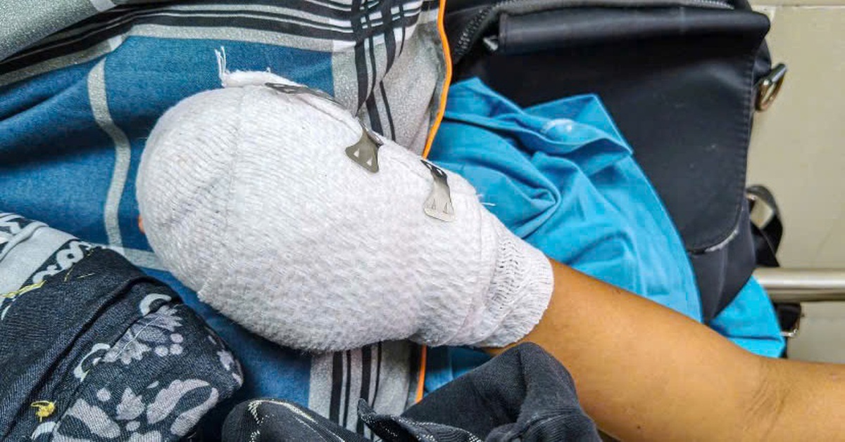 Bé trai bị dập nát bàn tay nghi do điện thoại phát nổ